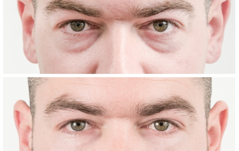 Harpers Bazaar: Everything you need to know about non-surgical eye bag removal