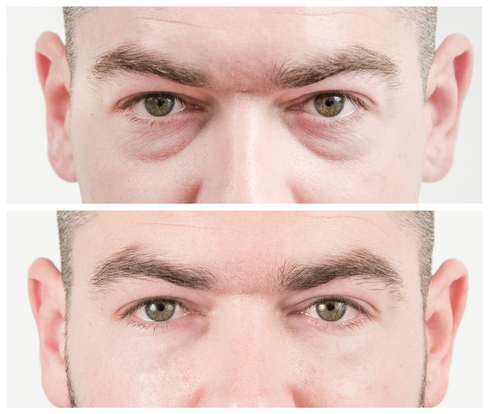 Harpers Bazaar: Everything you need to know about non-surgical eye bag removal