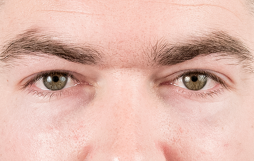 "I want to get rid of the tired look around my eyes!" Well, come and have this revolutionary eyebag treatment!