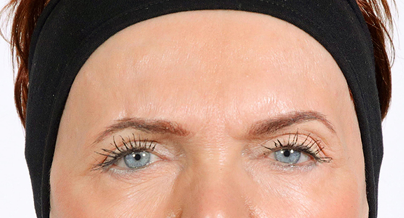 Baby injekcije za bore, Baby Botox, sl. 1 - poslije