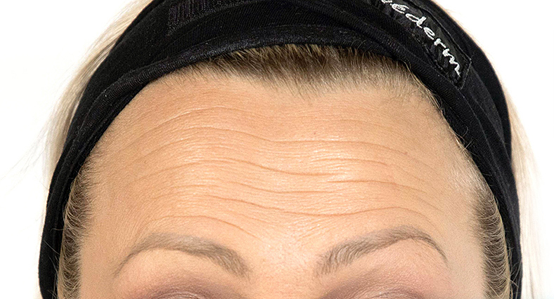 Baby injekcije za bore, Baby Botox, sl. 2 - prije
