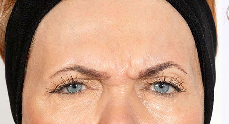 Baby injekcije za bore, Baby Botox, sl. 1 - prije
