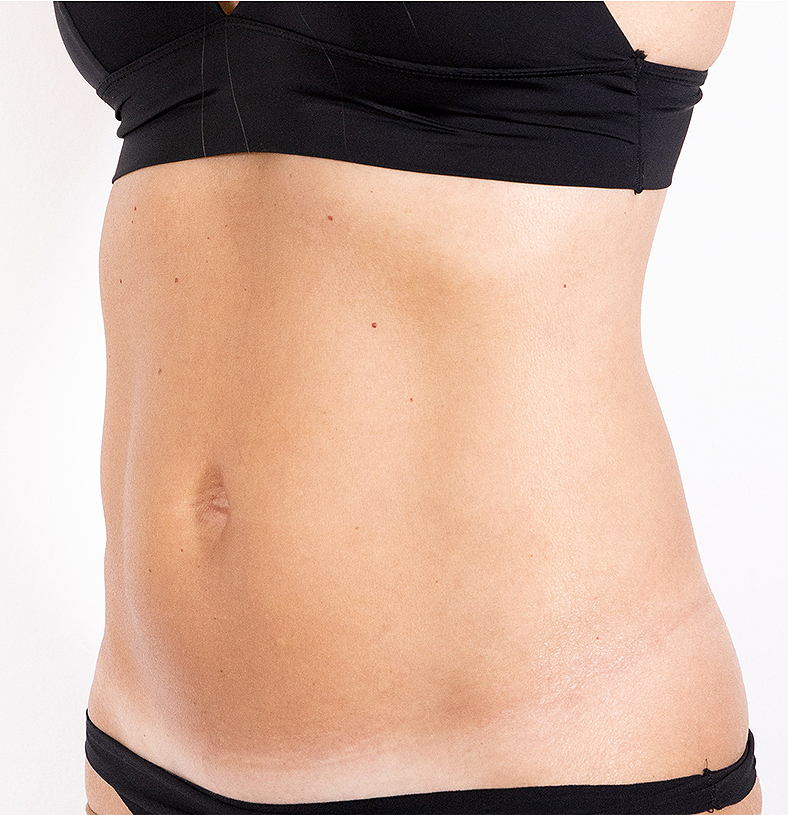CoolSculpting oblikovanje tijela, sl. 4 - poslije