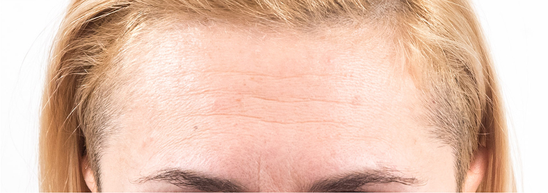 Baby Botox, prije