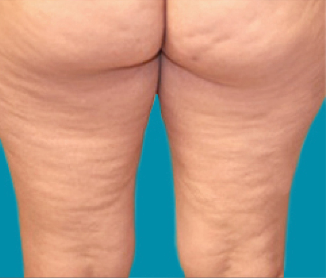 Body Shape - prije 4