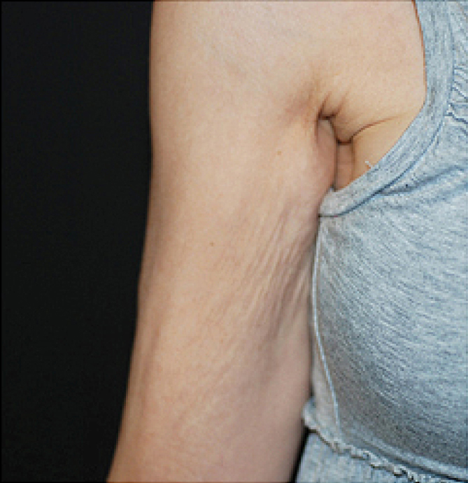 Body Shape and Tight - prije 2