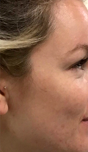 SkinPen, poslije 1