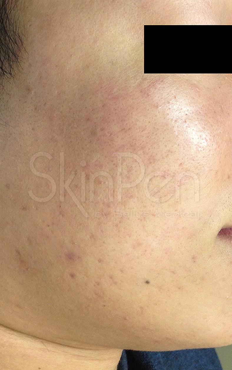 SkinPen, poslije 2