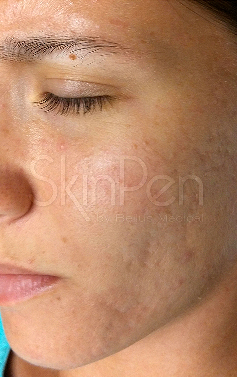 SkinPen, poslije 3