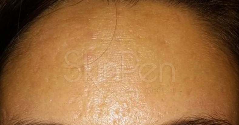 SkinPen, poslije 4