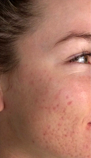 SkinPen, prije 1
