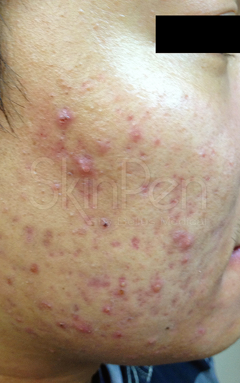 SkinPen, prije 2
