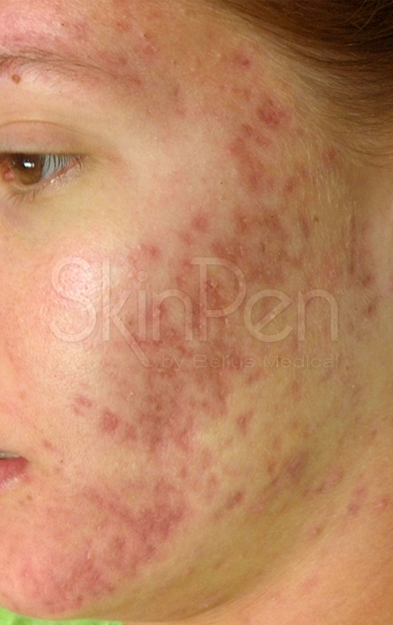 SkinPen, prije 3