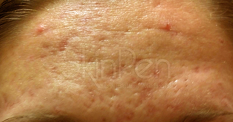SkinPen, prije 4