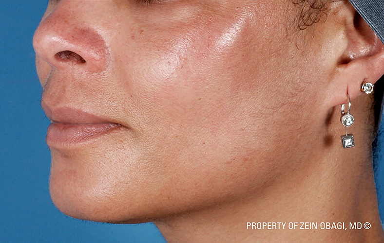 ZO Skin Health, sl. 2 - poslije