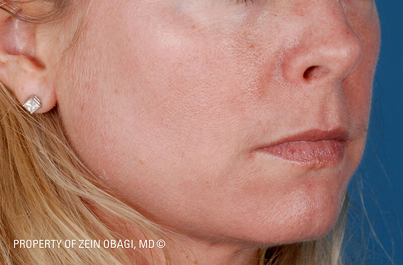ZO Skin Health, sl. 4 - poslije