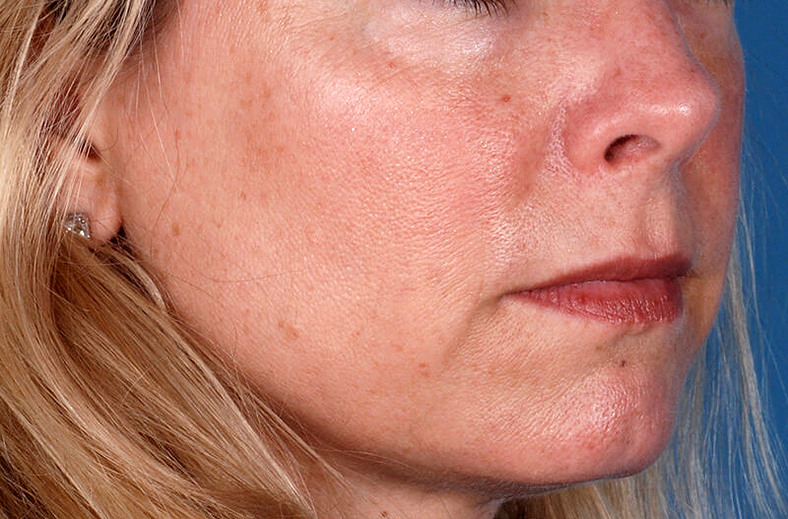 ZO Skin Health, sl. 4 - prije